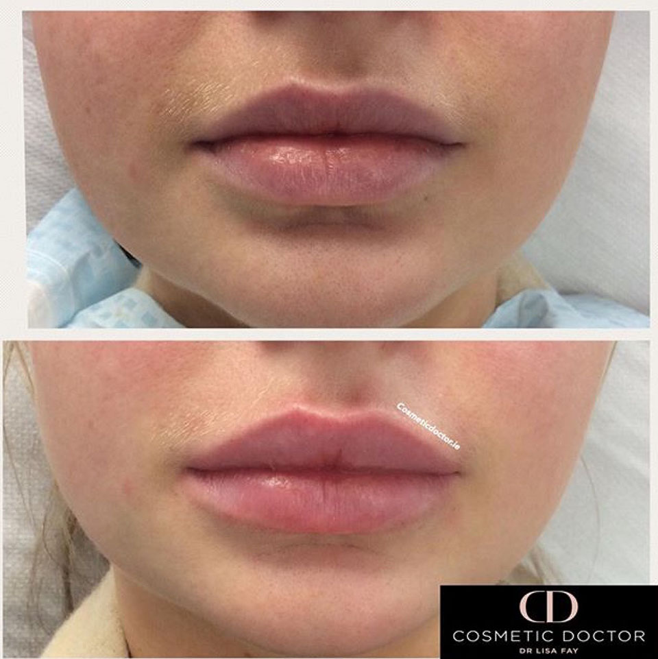 lip enhancement results using dermal fillers