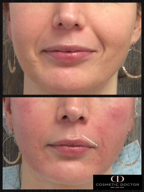 Before After Dermal Fillers For Nasolabial Folds Cosmetic Doctor