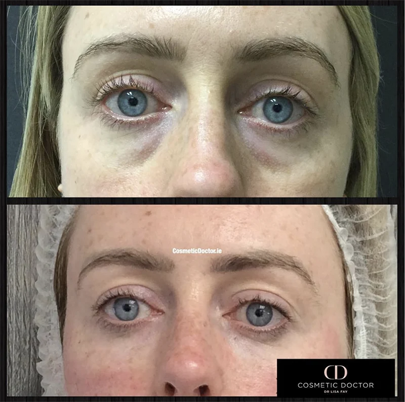 tear trough treatment results