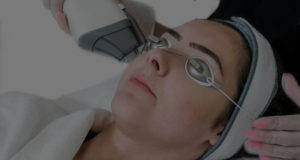 laser facial treatments